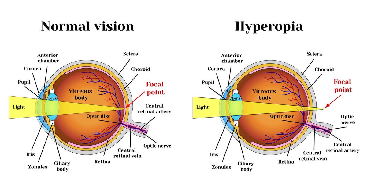 BecksOptical's tweet image. Common pediatric eye problems 

Hyperopia - Farsightedness ✍🏽

#SaveAsight 💫