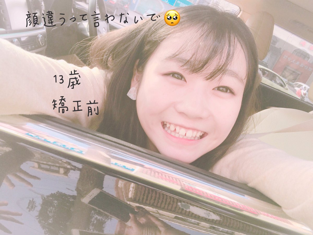 小5で八重歯が生えてきて抜歯してから段々と隙歯になったので13歳で