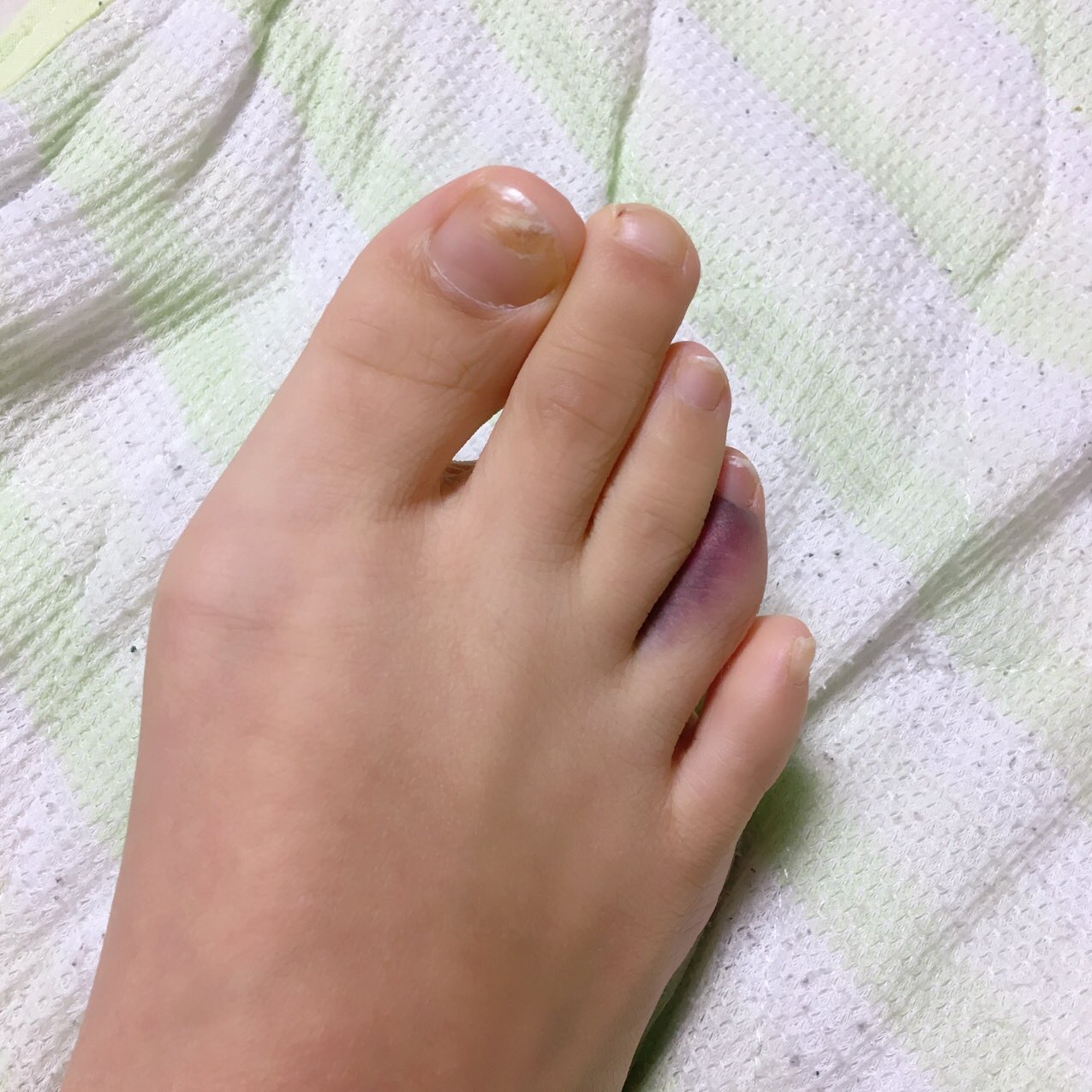 識海ましろ イカれた俺の右足のメンバーを紹介するぜ 爪が死んでる 親指 爪の中で内出血してる 人差し指 唯一無事 中指 今日の昼ぶつけてまだ痛みが続くので今靴下を脱いで確認したらめちゃめちゃ内出血してた 薬指 理由は分からないけど歪ん