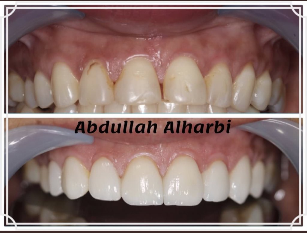 Dentist_List's tweet photo. حاله للدكتور عبد الله @abzalharbi في المستشفى الجامعي لجامعة ��ياض العلم.
تم تطوير الابتسامه والجميل أن النتيجه جداً طبيعه.. https://t.co/Z9WxP3pwbG