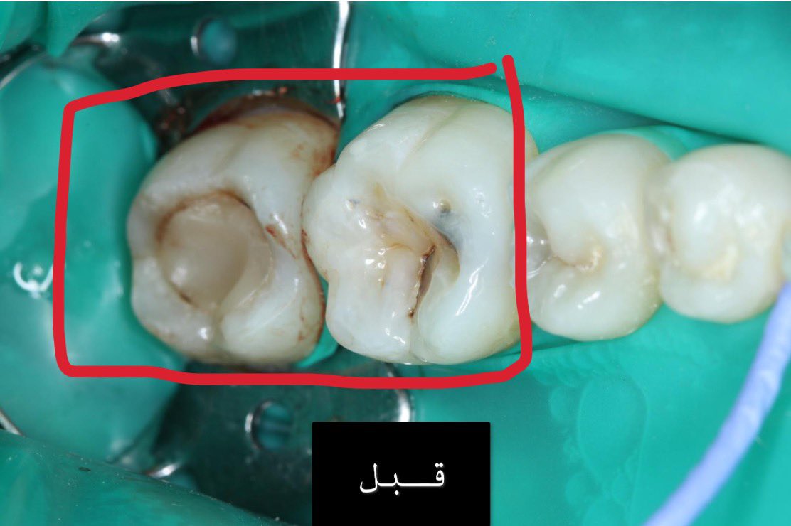 Dentist_List's tweet photo. هذي حاله للدكتور شهاب @Drshahabq8 , في المستشفى الجامعي لجامعة رياض العلم. https://t.co/7ULWrHS40y