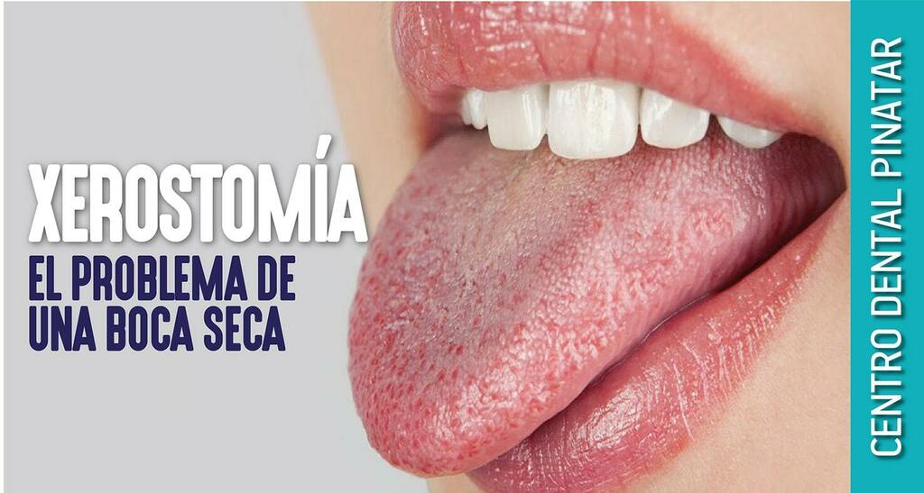 DentalPinatar's tweet photo. Nuevo Post Centro Dental Pinatar Xerostomia: el problema de una boca seca https://t.co/J3qWuO6aGv https://t.co/QbvpjtuOy8