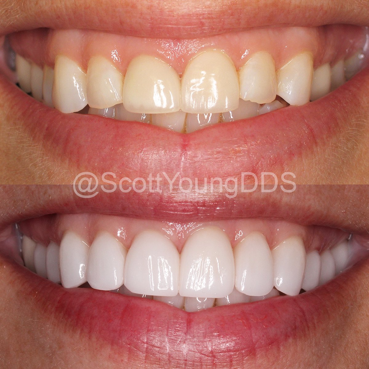 ScottYoungDDS's tweet photo. This teacher's stunning #smilemakeover was recently noticed by her young student π§, "she has sooooooooo much shiny tef"! π¦·β¨
#SmileWithConfidence #dentalart #smiledesign #neuromusculardentistry #cosmeticdentistry #porcelainveneers #htxdentist #woodlandsdentist #springdentist https://t.co/pNCie7S5Dj