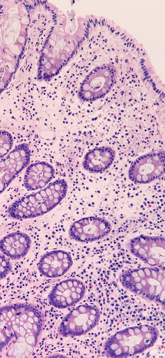 A potpourri of rare tropical and opportunistic infectious GI path: Part II! Any takers? 🌴🐛 #GI #GIpath #idpath #pathology