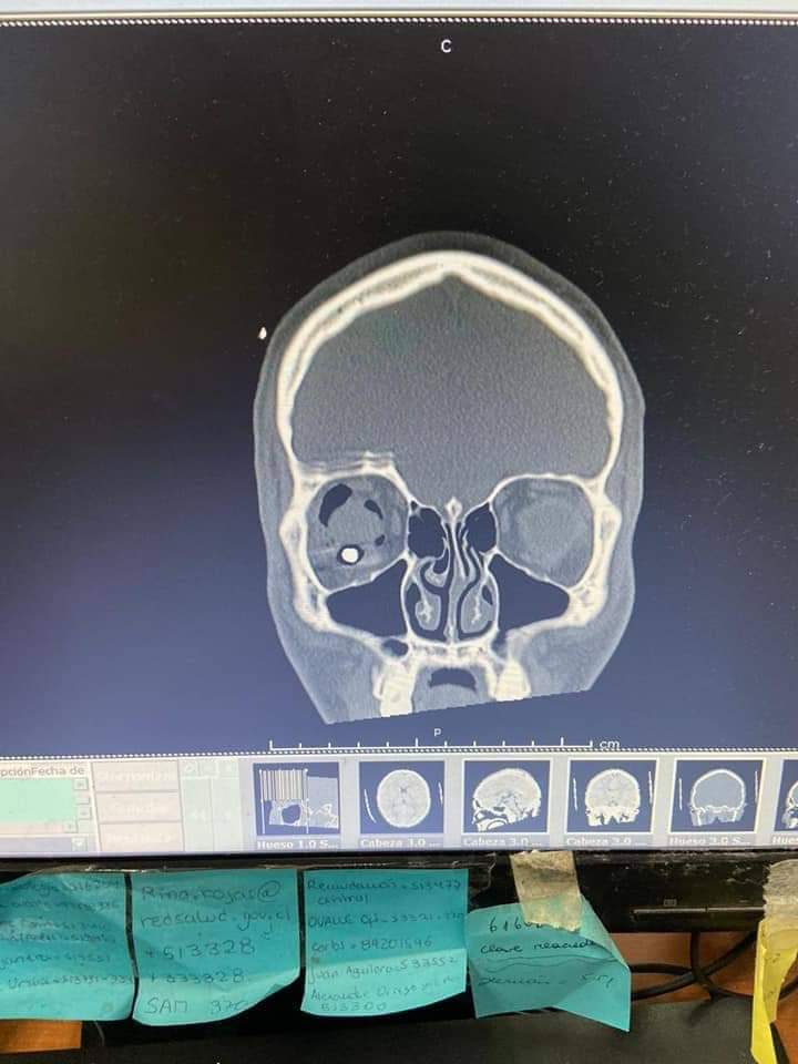 MarcelaHicks's tweet photo. Y los protocolos donde quedan?!
El estado de Chile sigue mutilando ...cuando son el garante de los DDHH.
Un niño de segundo medio de un liceo en Coquimbo
#GiovanniPino (su familia aut.publicacion)
@ValdebenitoNata 
@inddhh
@CIDH 
@CoquimboPereira https://t.co/npdof84ENL