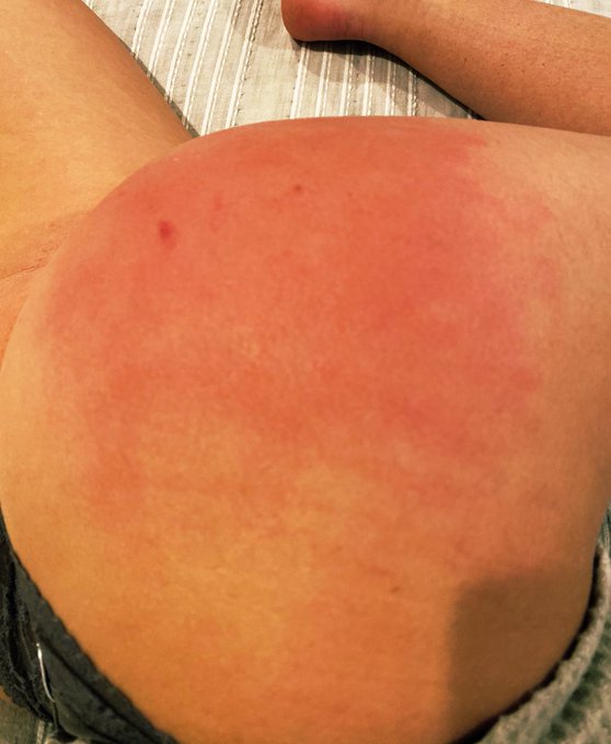 How that 🍑 should always look! During vs. 3 days later! #spankedass #HurtSoGood #amateur #spankme https://t<a href="/tag/amateur"class="tags"><span>#amateur</span></a><a href="/tag/spankme"class="tags"><span>#spankme</span></a><a href="/tag/hurtsogood"class="tags"><span>#hurtsogood</span></a><a href="/tag/spankedass"class="tags"><span>#spankedass</span></a>