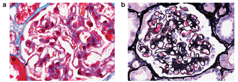 On light microscopy, the glomerular capillary loops appear prominent and there are fuscinophilic deposits on trichrome stain (a) and may be the formation of spikes and holes on silver stains (b), as also seen in membranous glomerulopathy (it’s membranous-like).
