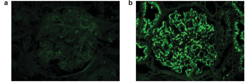 On immunofluorescence microscopy, IgG is negative in a majority of cases (a). However, pronase digestion on FFPE tissue will lead to “unmasking” of immune deposits, which will be positive along the glomerular capillary loops and frequently also within the mesangium (b).