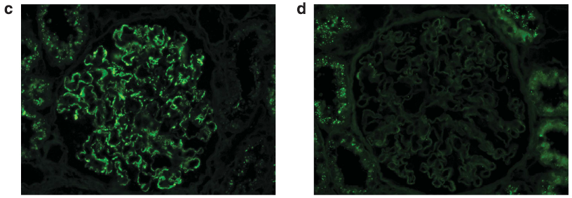There is unmasked kappa (c), but not lambda (d), light chains in the same distribution as IgG on paraffin immunofluorescence.