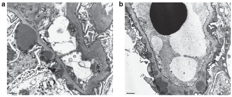 Electron microscopy often shows subepithelial and intramembranous deposits, and frequently also shows mesangial immune deposits.