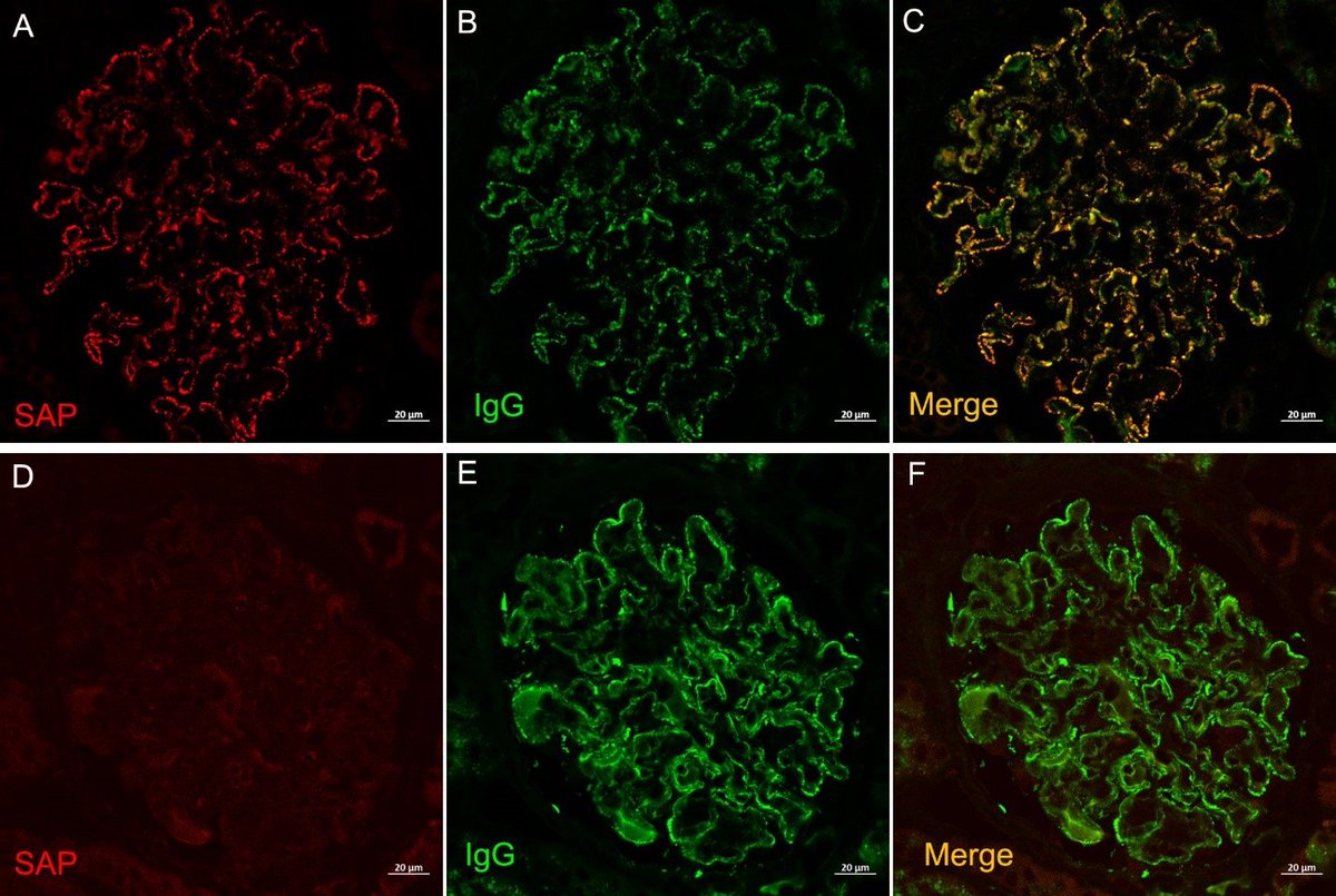 SAP was expressed in a granular capillary loop (and sometimes mesangial) pattern within glomeruli and showed co-localization with IgG within glomerular deposits (c). PLA2R positive MN is shown in the bottom panels as a negative control, which shows no staining within glomeruli.