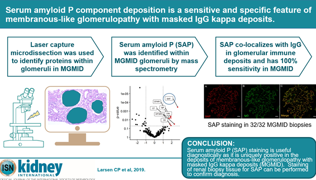 Membranous-like Glomerulopathy with Masked IgG kappa Deposits (MGMID) is an immune complex-mediated kidney disease, usually affecting young women. This work is by  @renalpathdoc and  @NephroRock, who recently identified a useful biomarker for MGMID, serum amyloid P (SAP).