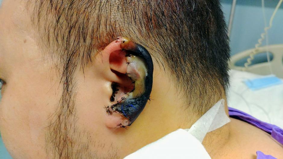 先日街で親中派に耳を噛み切られた香港の民主派区議員が 今日声明を出しました 耳は再接着されましたが 噛み切られた耳の大部分の軟骨組織が ひどく破壊されていて 接着した部分は壊死していたため 壊死した部分を手術で取り除く必要があります すなわち この傷は