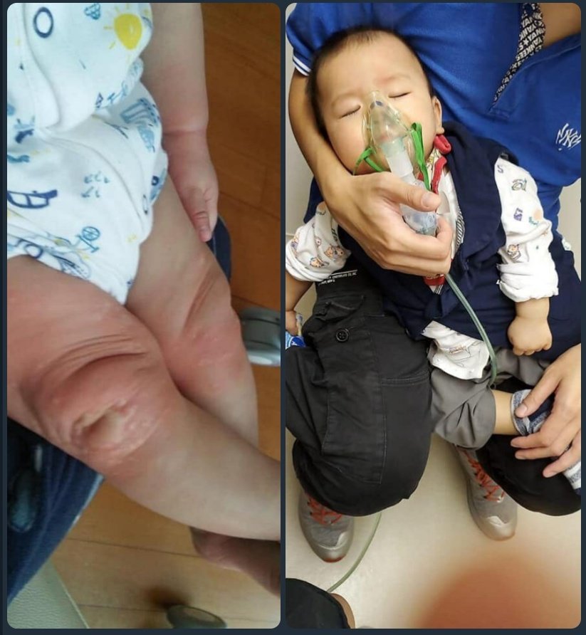 香港デモ情報 催涙ガスに接触した赤ちゃんの様子 皮膚がアレルギー症状があり 呼吸器も影響される 直撃されなくても化学物質が建物に残留する かつ 政府が催涙ガスの成分を把握してないと公表した 香港の観光スポットは基本催涙ガスに浴びたため