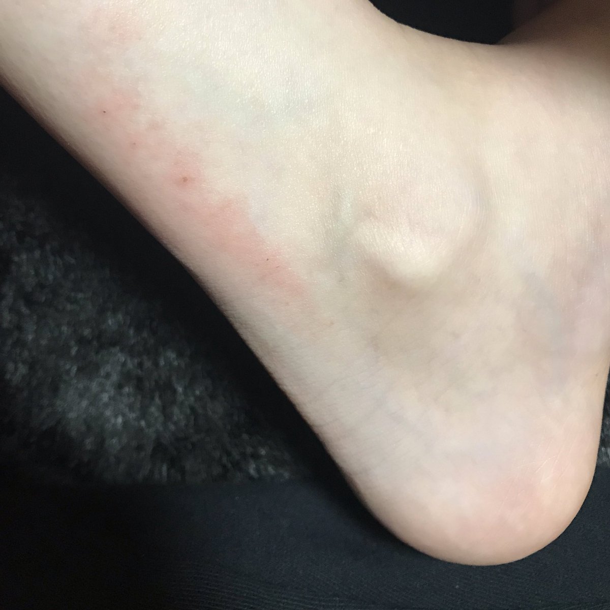 妊婦湿疹 妊婦湿疹