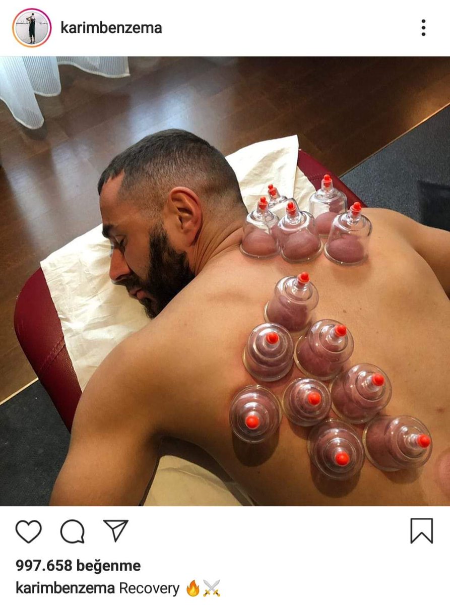 İspanya La Liga da Real Madrid'in yıldız oyuncusu Karım BENZAMA hacamat (Kupa Terapisi) yaptırdı. Kendi sosyal medya hesabından da hacamat yaptırırken fotoğrafını paylaşarak altına iyileşme notu düştü.