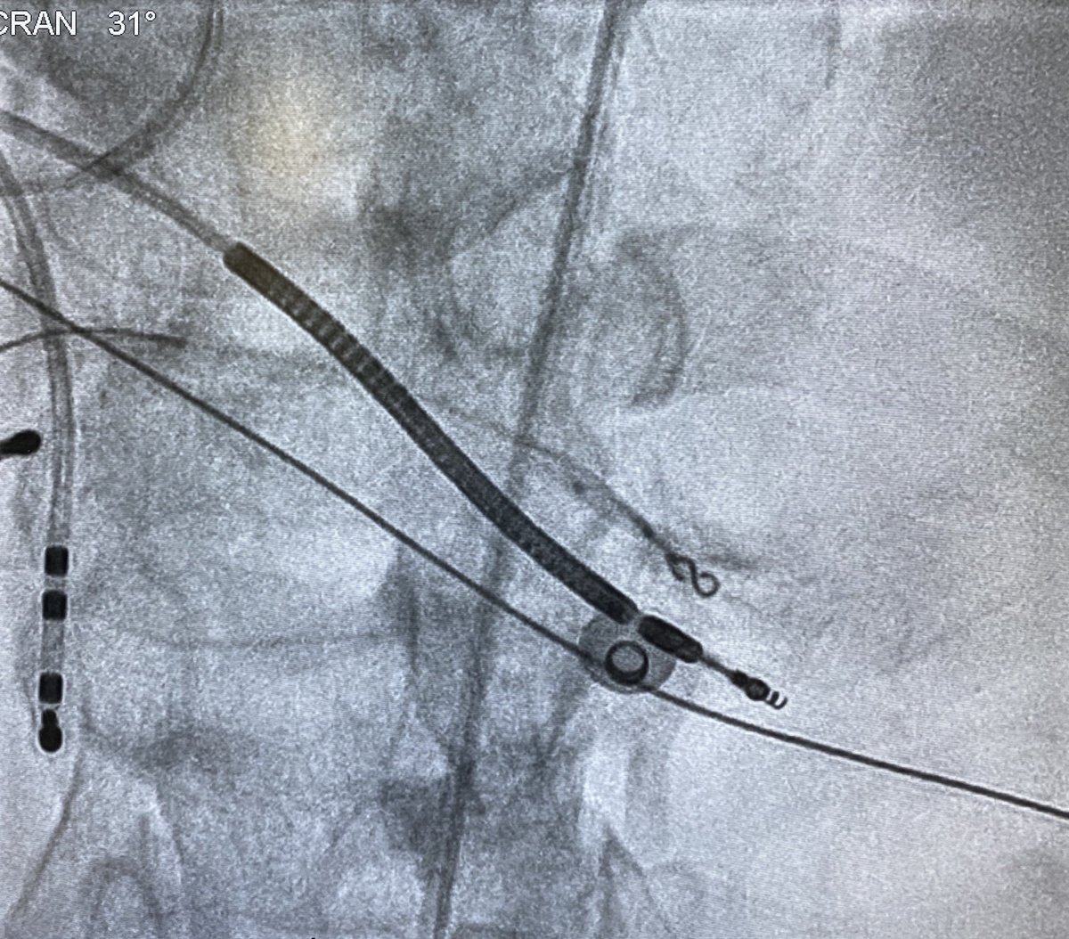 Eric Lim (@erictslim) on Twitter photo <a href="/murphy_lzy/">Murphy Lyu</a> <a href="/sachinjv/">Sachin Vadodaria</a> <a href="/Hapa_EP/">Kevin Brady</a> <a href="/JeffZhanghk2017/">Jeff Zhang</a> <a href="/Mya49099911/">M</a> <a href="/AbbottCardio/">Abbott Cardiovascular</a> This was the septal VT from today, Murphy. No maps since we’d mapped it previously. First pic shows termination with cold saline in RPDA. Wire mapping shows concealed entrainment with TCL-PPI of zero. Coiling+gel foam in distal RPDA renders VT uninducible <a href="/murphy_lzy/">Murphy Lyu</a> <a href="/sachinjv/">Sachin Vadodaria</a> <a href="/Hapa_EP/">Kevin Brady</a> <a href="/JeffZhanghk2017/">Jeff Zhang</a> <a href="/Mya49099911/">M</a> <a href="/AbbottCardio/">Abbott Cardiovascular</a> This was the septal VT from today, Murphy. No maps since we’d mapped it previously. First pic shows termination with cold saline in RPDA. Wire mapping shows concealed entrainment with TCL-PPI of zero. Coiling+gel foam in distal RPDA renders VT uninducible