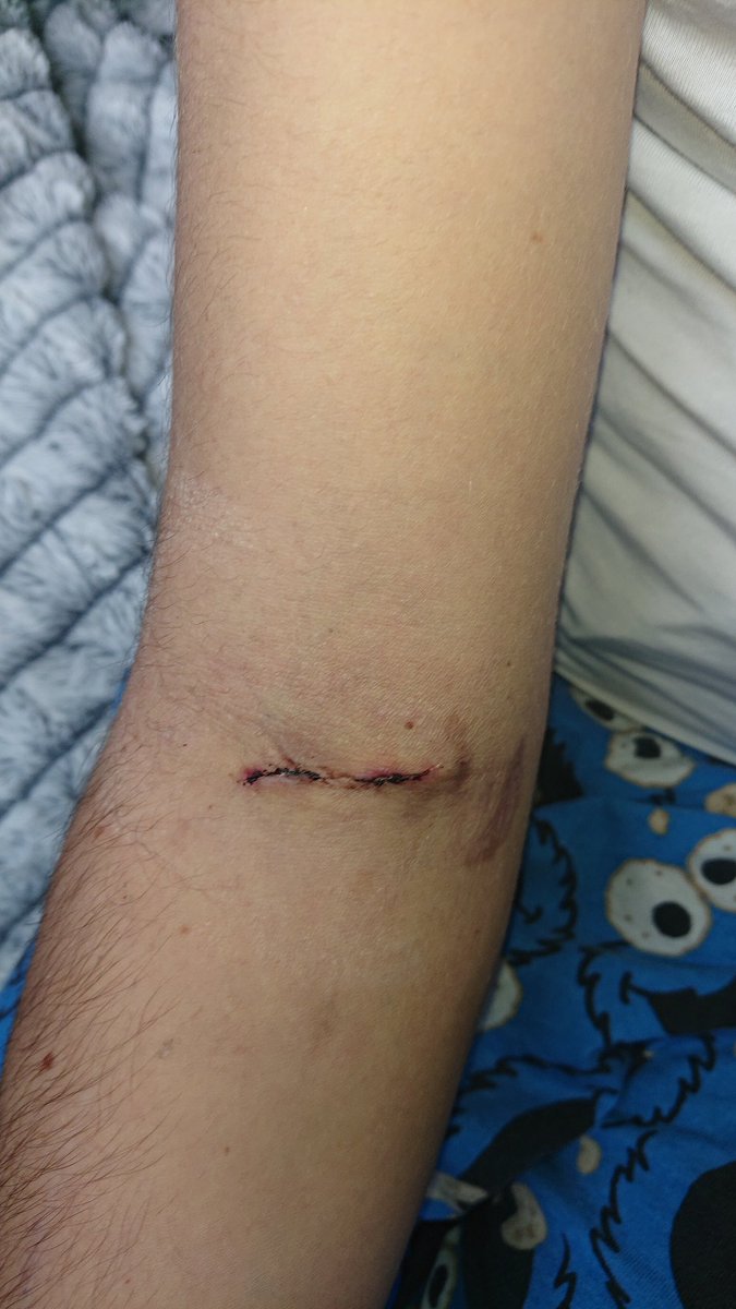 I'm 10 days post op. I think it's super tidy and I have a great thrill all the way to my shoulder blade. Great #vascular team <a href="/BetsiCadwaladr/">Betsi Cadwaladr</a> and a massive thank you I can't wait to start #needling #teamnocturnal #SelfCare #dialysis #homehaemo  #AVfistula <a href="/WelshVANS/">welshvascularaccess</a>