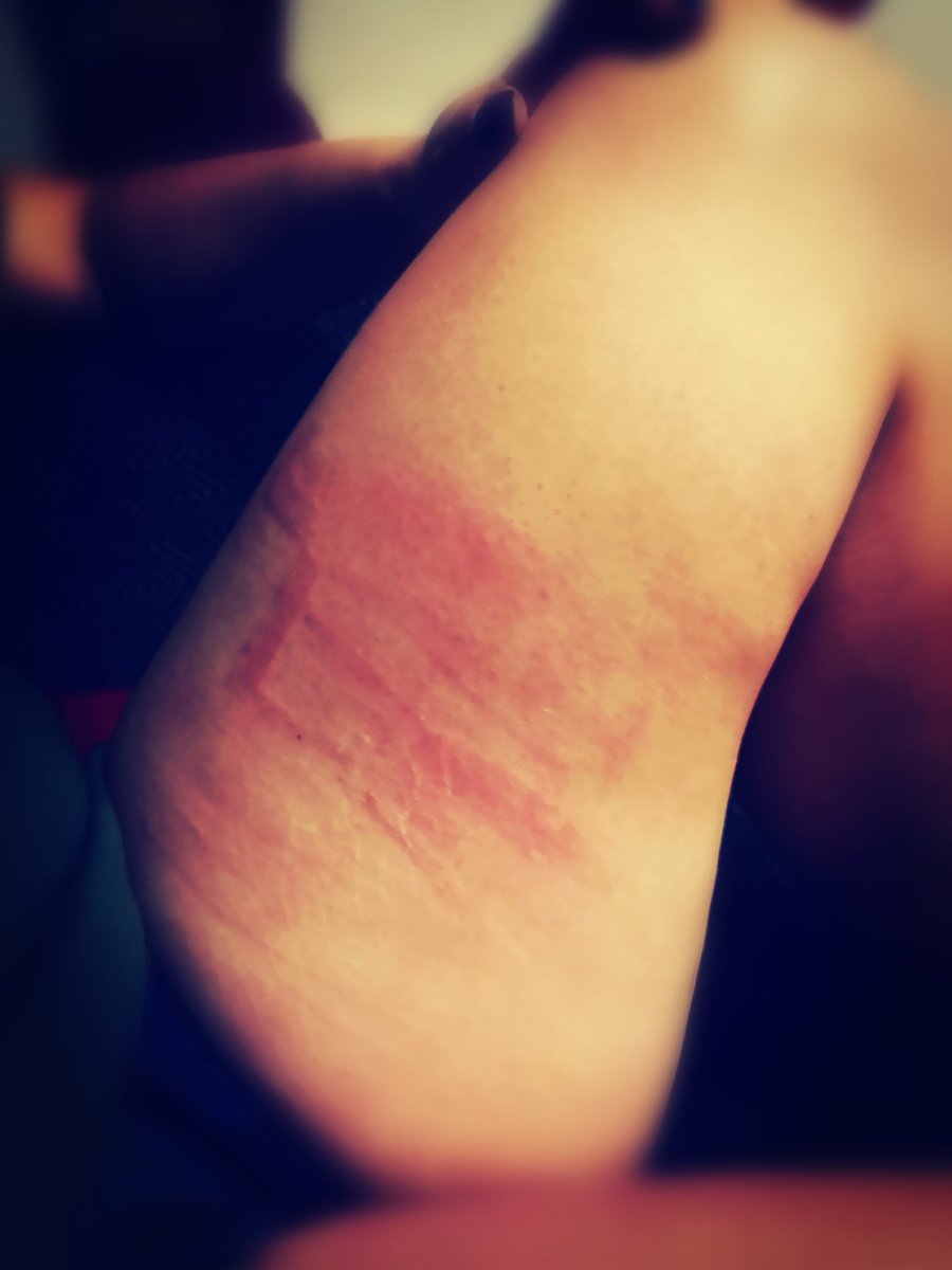 CNorines's tweet photo. I needed some #punishment I have been a bad girl #withconsent #Daddyknowswhatilike #beltmarks #beltbuckle #iearnedthese #badgirl #hotasfuck https://t.co/eVnIvlWalQ