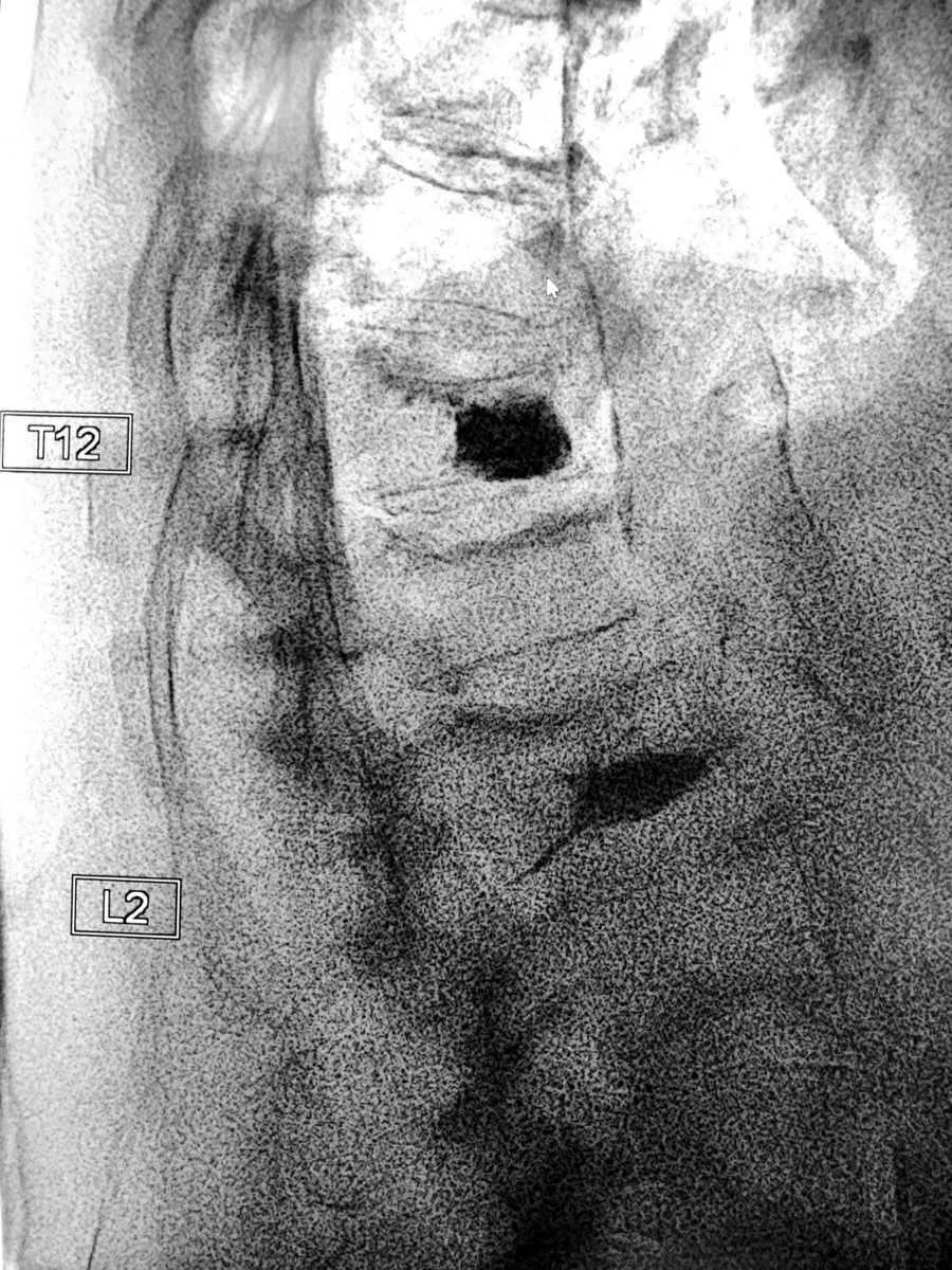 #Vertebroplasty for treatment of painful, acute compression fractures utilizing #kyphon curved needle for unipedicular access. rapid pain relief &amp; improved mobility #painrelief #irad <a href="/guthrie_ir/">GuthrieIR</a>