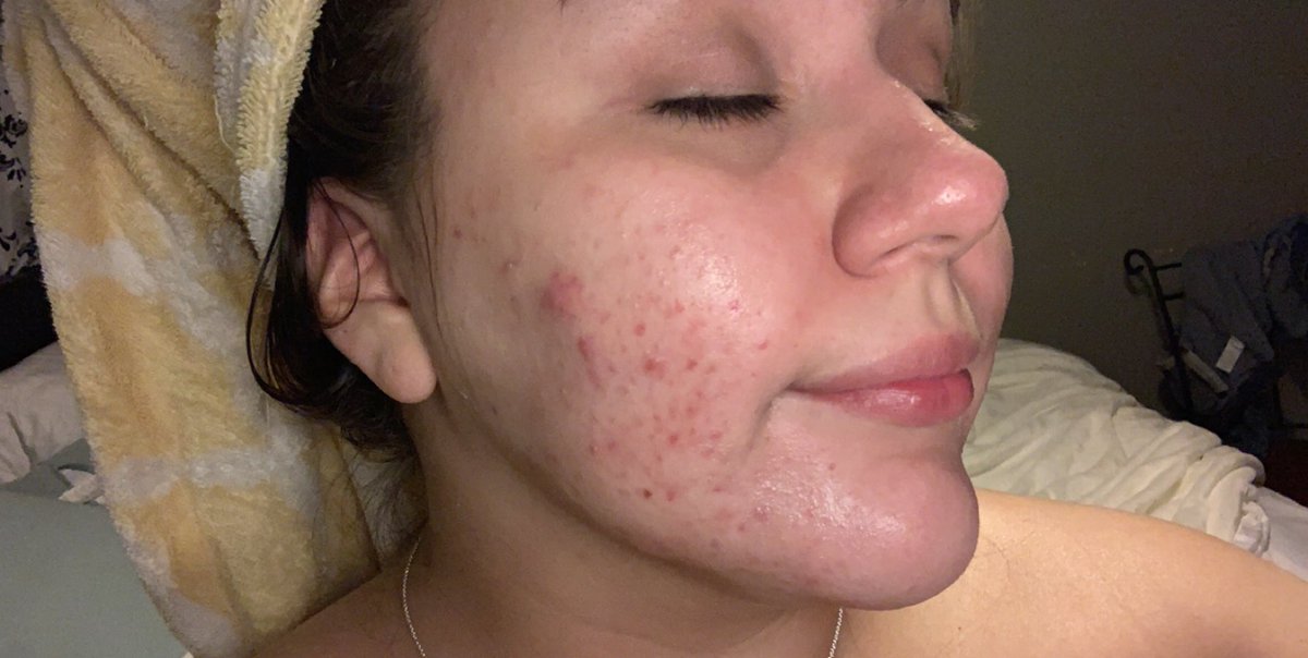 J On Twitter Thxbirthcontrol Friendly Reminder That Birth Control Is Not Only Used For Preventing Pregnancy But Also For Acne Painful Periods Irregular Menses Pcos Endometriosis Etc Https T Co A7t24mrvbl