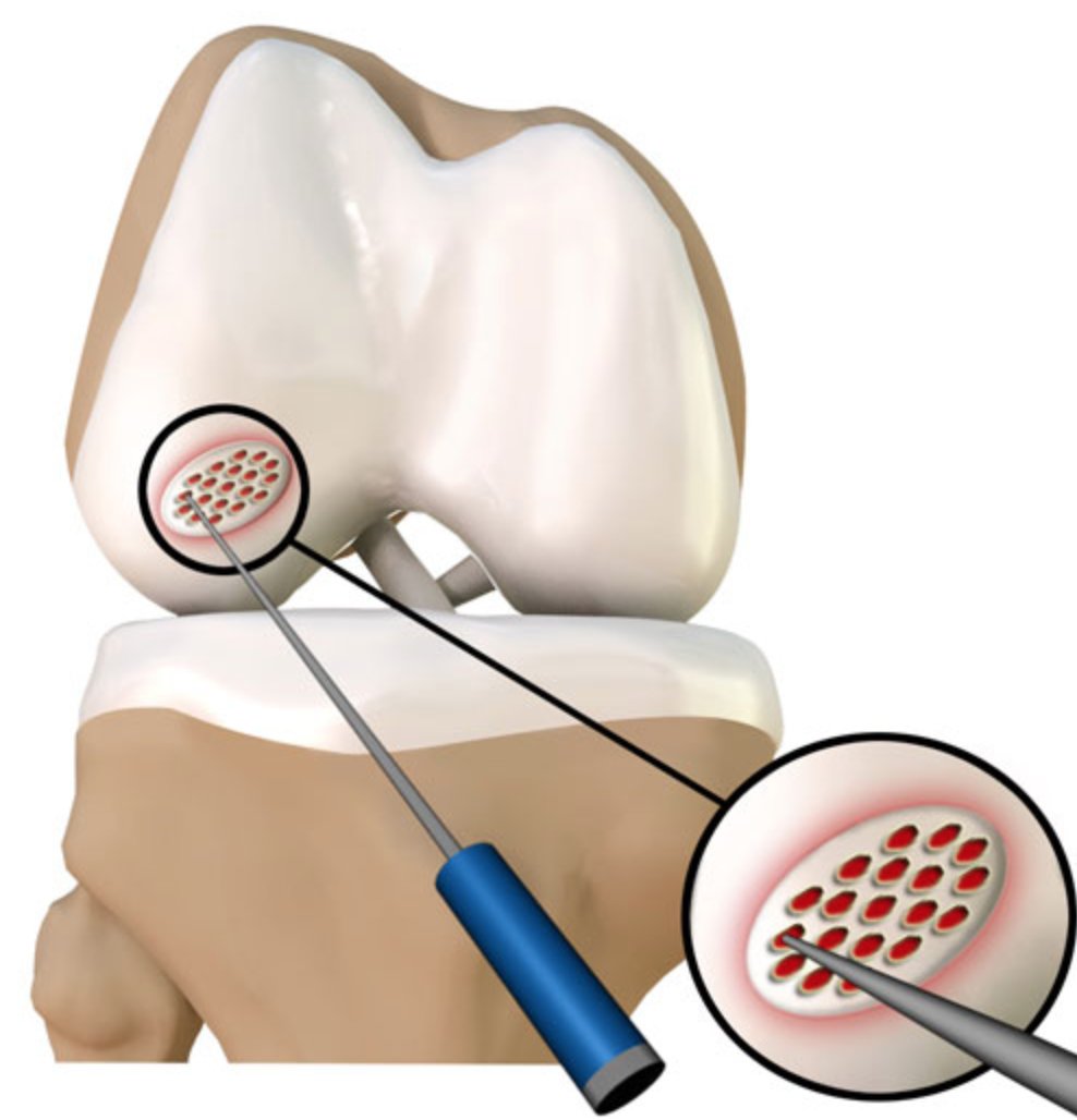 After #ArticularCartilage damage has been diagnosed, what factors indicate #microfracture ?

-The patient has a full-thickness defect in either a weight bearing area between the femur and tibia or in an area of contact between the back of the patella...