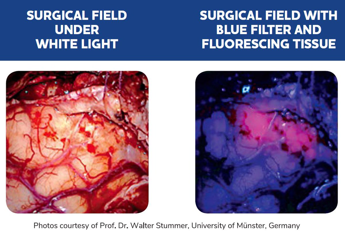 Prevea's tweet photo. Prevea Health neurosurgeon, Dr. Joseph Chabot, became the first in #Wisconsin to use Gleolan™, a new, breakthrough tool designed to make the surgical removal of high-grade gliomas more effective. The surgery was performed at @stvgb: https://t.co/Au890di1dk https://t.co/6DtNERELjG