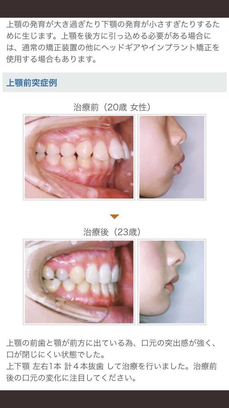 泣きぼくろちゃん 歯列矯正で頬こけたとかほうれい線 できたとかよく聞くけど あれもともとeラインある人の話だとおもうんだよね 私は歯茎から前に出てるタイプだったけど抜歯矯正したらうまいこと口元引っ込むわ ほうれい線なくなるわ人中も短くなるわで