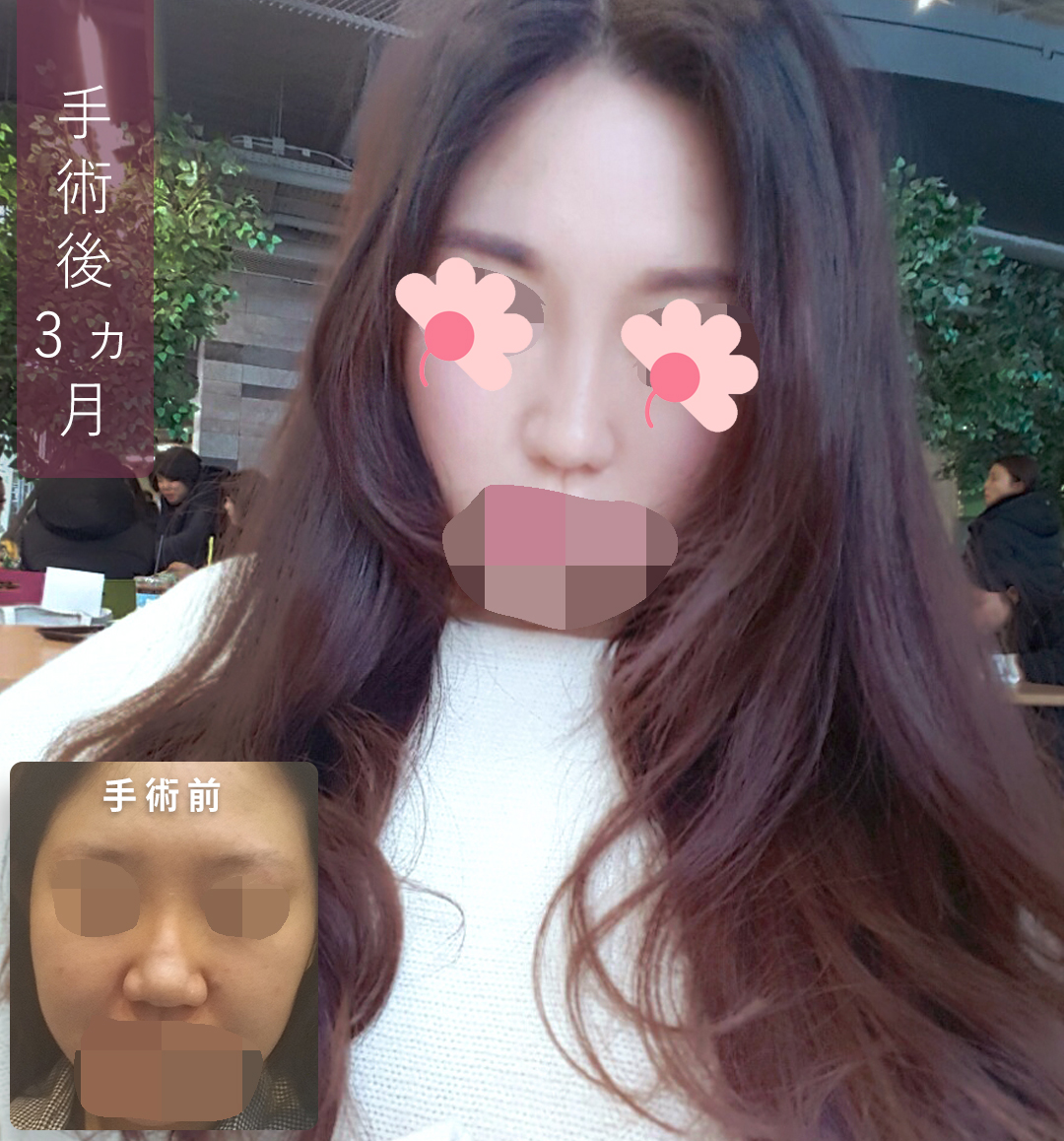 gamipsjapan's tweet photo. 💜鼻の手術💜
とにかく大きくて、存在感がありすぎる
鼻が嫌で、手術を検討している中で
団子鼻の手術で有名な病院をいくつか回り
その中で一番惹かれた病院に決定しました！
今の時点でも十分に鼻が小さくなって
満足していますがこれからもまだ変化して
行くと思うので、とても楽しみです💞 https://t.co/9QeqCI8CEh