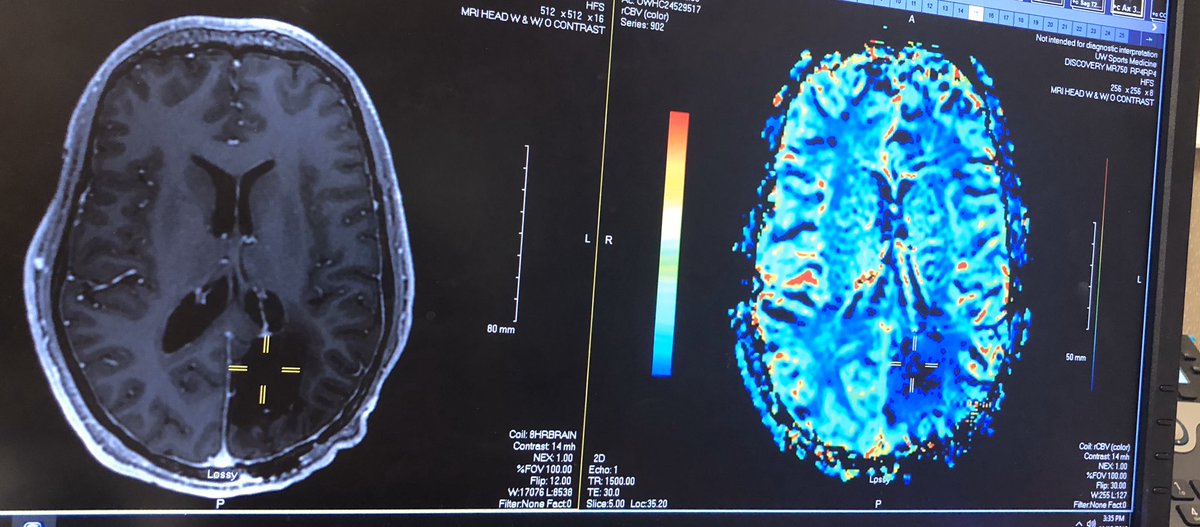 AmandaPitzo's tweet photo. #Glioblastoma 11 months post surgery, a year after the first surgery. #ClearScan. If you don’t understand #Scanxiety, educate yourself. #thankful for a stable scan! #FindACure #Novucure #Optune usage @ 98%, it is working. Give your patients the option, the lifeline. https://t.co/QyOjnRbpjN