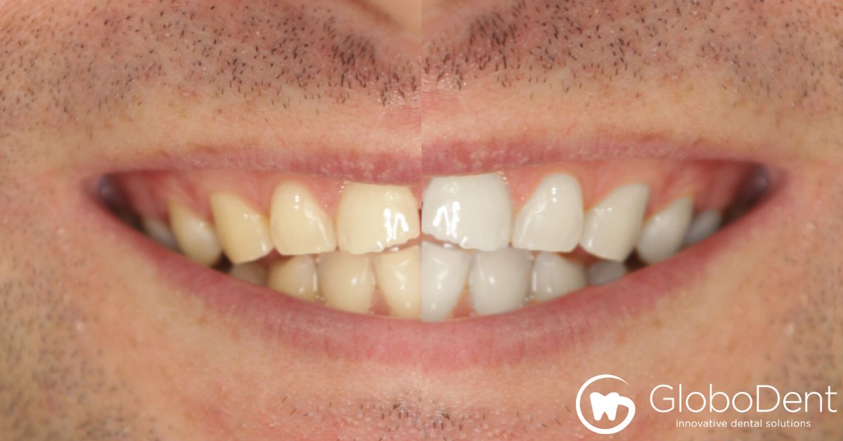 globodent's tweet image. We&apos;re looking for #globaldistributors who want to provide bright, white #smiles worldwide. If you&apos;re interested in helping people achieve the perfect smile they deserve, email: info@globodent.com to learn how you can become a GloboDent distributor.