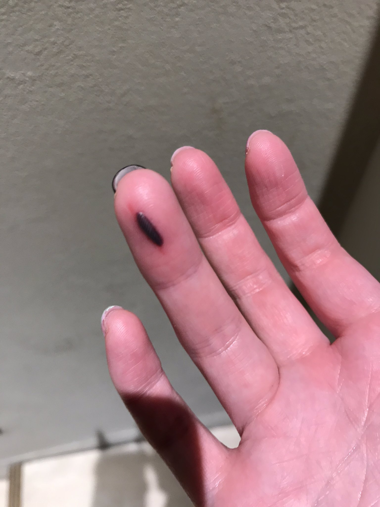 山田さつき チマメ痛いねん 血豆 痛い画像 閲覧注意 T Co Kp428rpiax Twitter