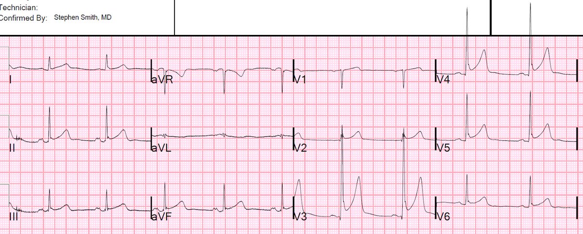 A 50-something with left shoulder pain and diffuse ST elevation  

hqmeded-ecg.blogspot.com/2019/11/a-50-s…