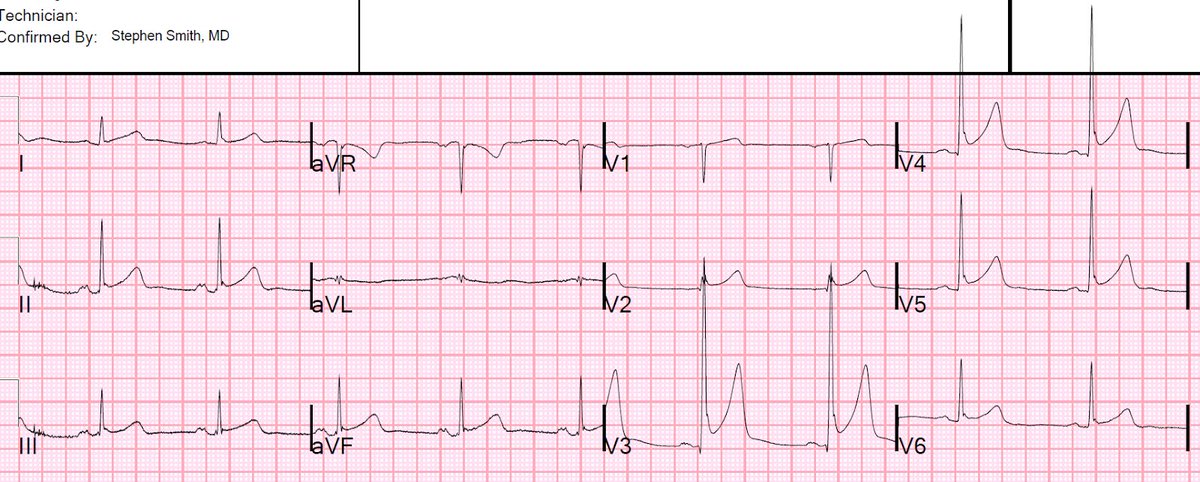 A 50-something with left shoulder pain and diffuse ST elevation hqmeded-ecg.blogspot.com/2019/11/a-50-s…