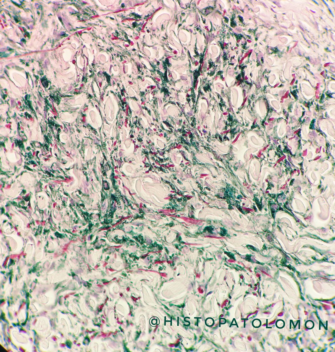 Histopatolomon's tweet photo. We all know the #bluenevus but does the #greennevus exist? Do you know what stain is this? #histochemistry #MelaninPigment #pathology #dermatology #dermpath #Nevusazul #nevusverde?
#TEAPyC @lara_pijuan @edusqo @janeirosf @VirginiadeLucas @PequenaTeap @tralimiguel @ijexpafo https://t.co/fw9oqxNB0n