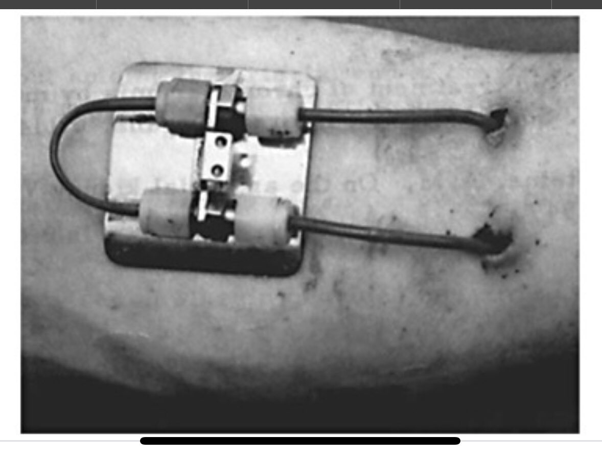 Historic day for AV-Access: this 72 y/o female patient is (to my knowledge) the very first patient in the Milky Way, who has had the oldest (#Scribner-Shunt) and the newest (#EllipsS pAVF) in same arm in &gt;30 years! Failing NTx, Ellipsys with 720ml/min procedural flow in 12 min.