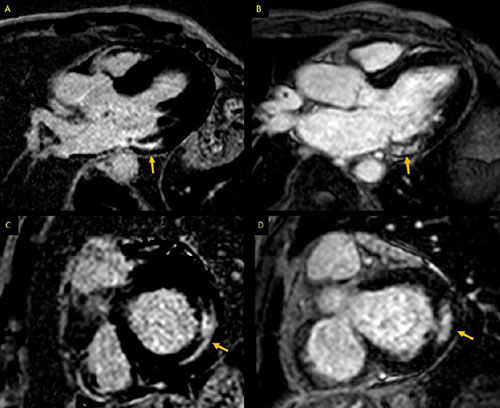 Multimodality cardiac imaging assessment of Fabry disease: diagnosis, monitoring, and future applications #AHAJournals @venkmurthy @ZainabASamad ow.ly/bvqU50xaNEW