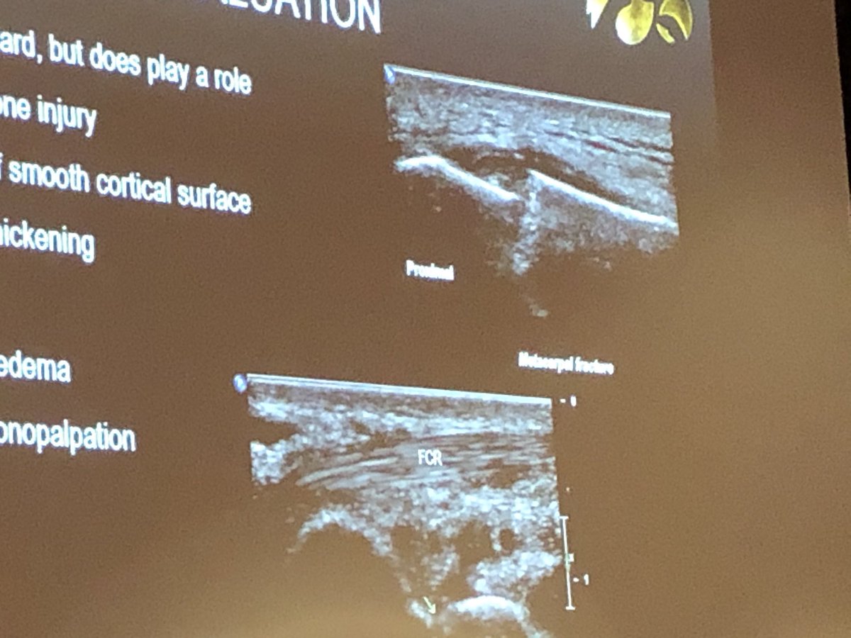 Jonathan Finnoff, DO (@finnoffjonathan) on Twitter photo Ryan Kruse did a great job stepping in for <a href="/mederichall/">Mederic Hall</a> at #AAPMR2019 advanced sports US session. Nice pic of fracture. Great discussion of eFAST. Loved the description US return to sports criteria following muscle strain. Cutting edge info. <a href="/mayoclinicsport/">Mayo Clinic Orthopedics and Sports Medicine</a> Ryan Kruse did a great job stepping in for <a href="/mederichall/">Mederic Hall</a> at #AAPMR2019 advanced sports US session. Nice pic of fracture. Great discussion of eFAST. Loved the description US return to sports criteria following muscle strain. Cutting edge info. <a href="/mayoclinicsport/">Mayo Clinic Orthopedics and Sports Medicine</a>