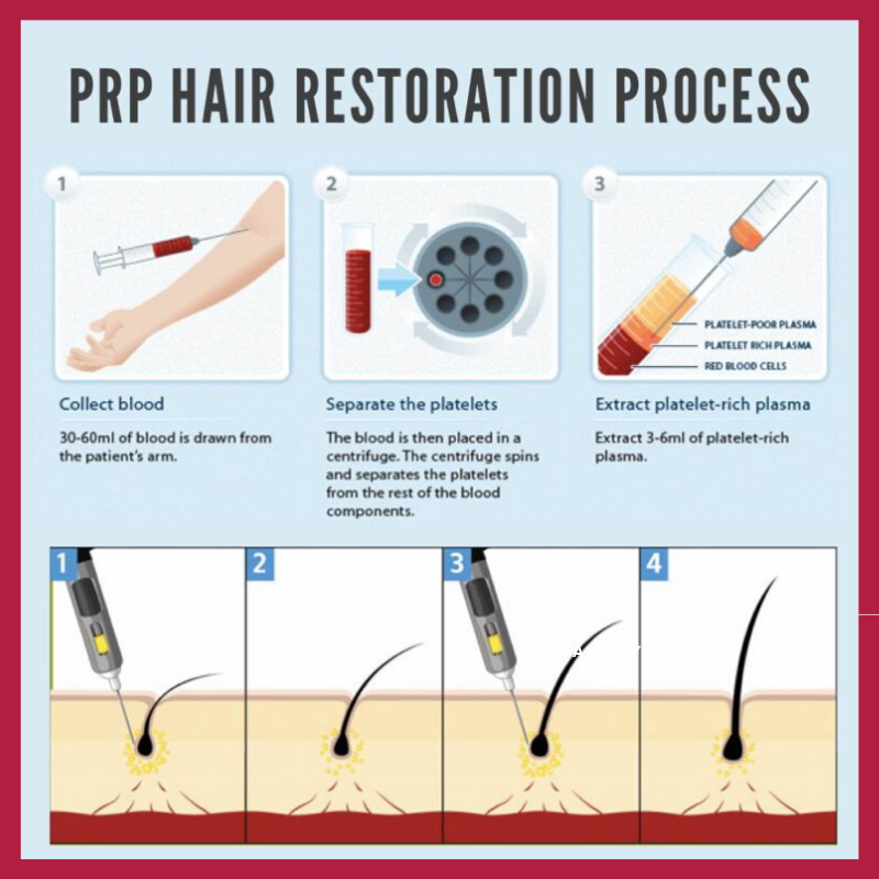 sunidhi39's tweet photo. PRP #hairtreatmentinMumbai is the best choice for people who have tried all other forms of pills and lotions for control of hair fall and hair growth. For more information please visit- https://t.co/9ac2teNX36
#hairtransplantmumbai https://t.co/Jk6NhyAANK