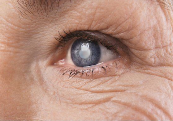 EyeCareDelhi's tweet photo. Learn more about the most effective form of cataract surgery

To know more read the blog:https://t.co/FO21RK8Jzg https://t.co/wW2sGPURJg