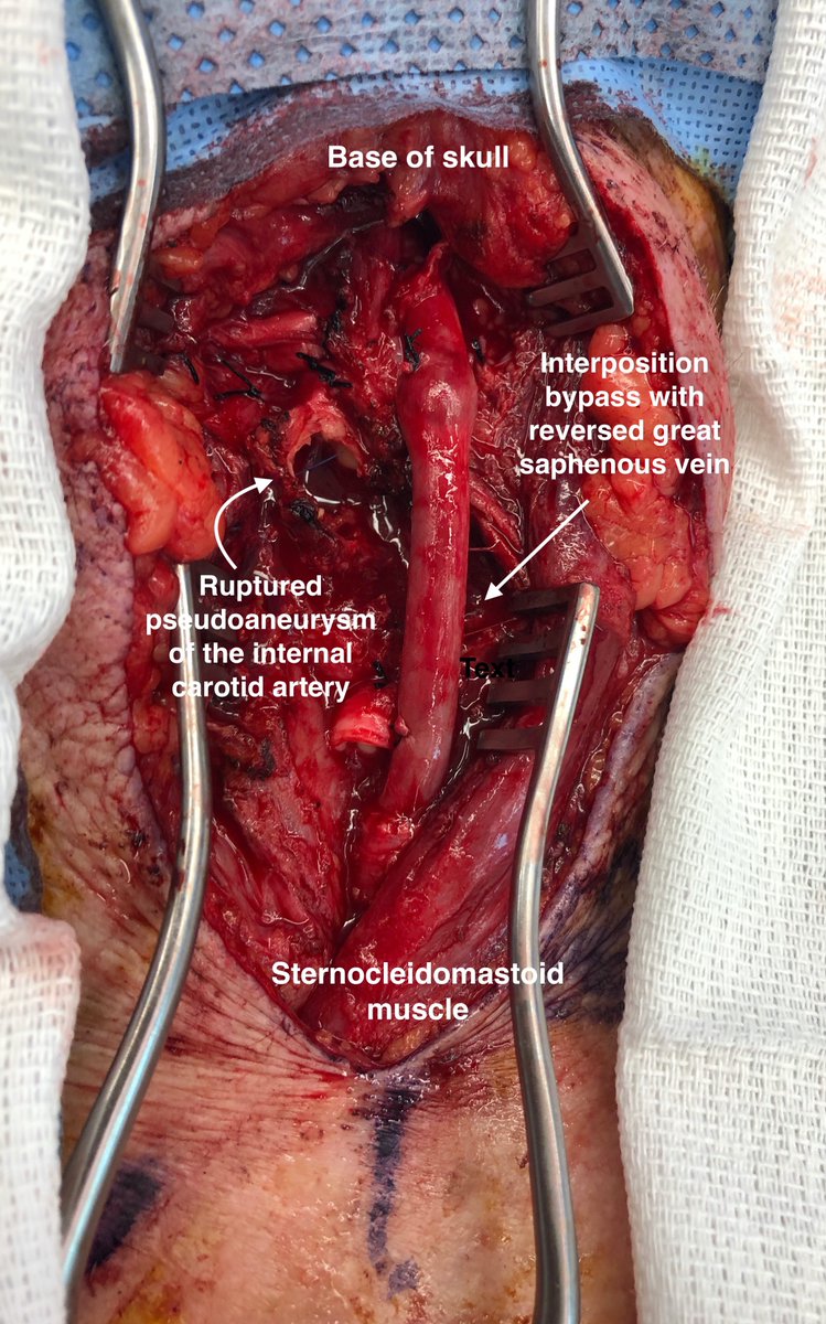 This patient presented to the hospital with bacteremia and enlarging neck mass. The patient was found to have a contained, ruptured pseudoaneurysm of the ICA. This was repaired with interposition bypass with saphenous vein and ligation of the ECA. #vascularsurgery #pseudoaneurysm