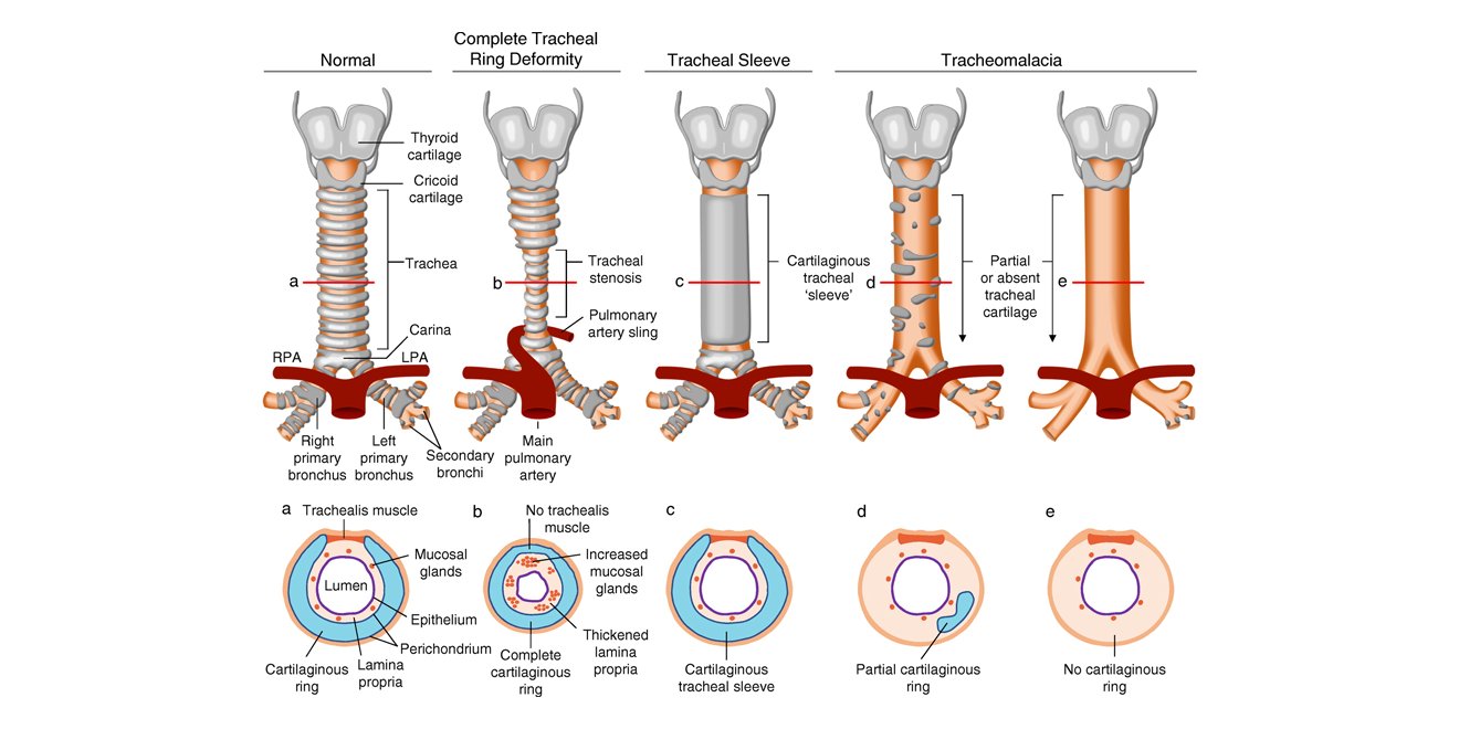 Tracheal Anomalies: Complete Tracheal Rings, Tracheomalacia, and Vascular  Compression | Ento Key