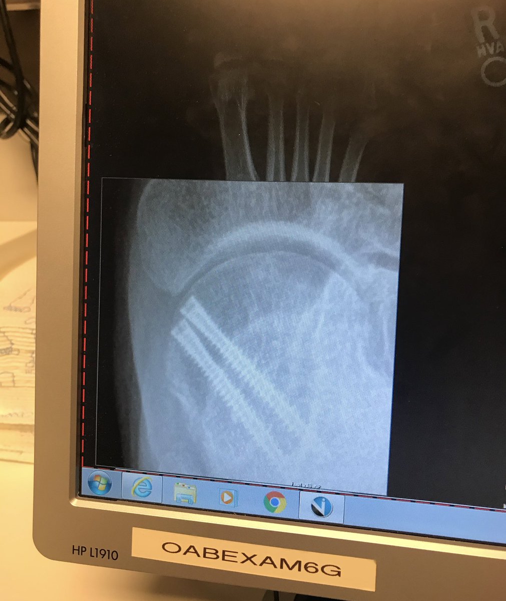 A big thank you to Dr. Johnny Lin @ Rush orthopedics for fixing my broken ankle. May 30 vs Nov 22.