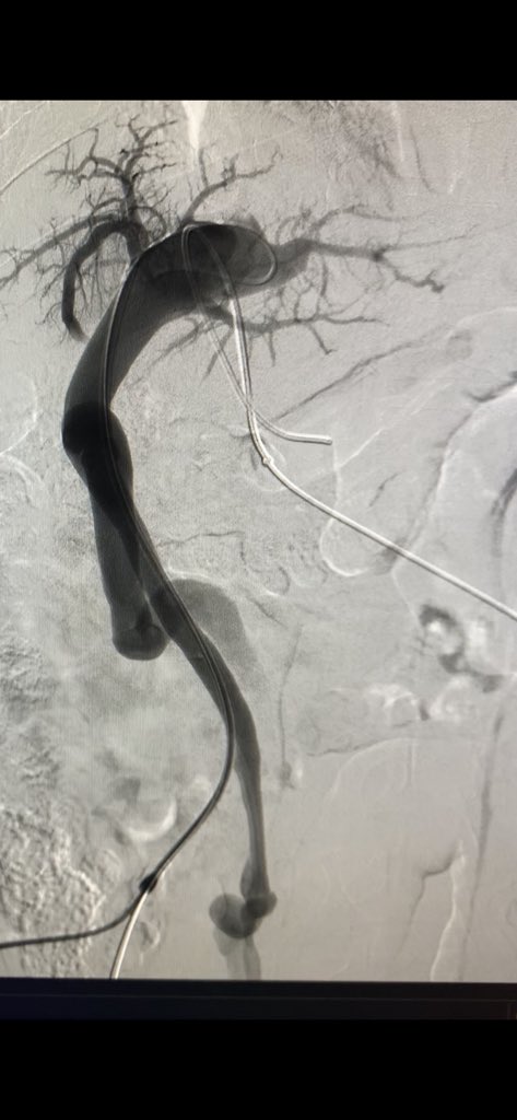 icasanovamd's tweet photo. Umbilical #portosystemic  #shunt + #encephalopathy. #endovascular  plugging procedure @incmnszRxInt . #iRad #interventionalradiology #vascularplug #Mexico https://t.co/Xxgx7Zg1lu