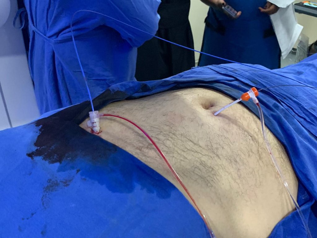 icasanovamd's tweet photo. Umbilical #portosystemic  #shunt + #encephalopathy. #endovascular  plugging procedure @incmnszRxInt . #iRad #interventionalradiology #vascularplug #Mexico https://t.co/Xxgx7Zg1lu
