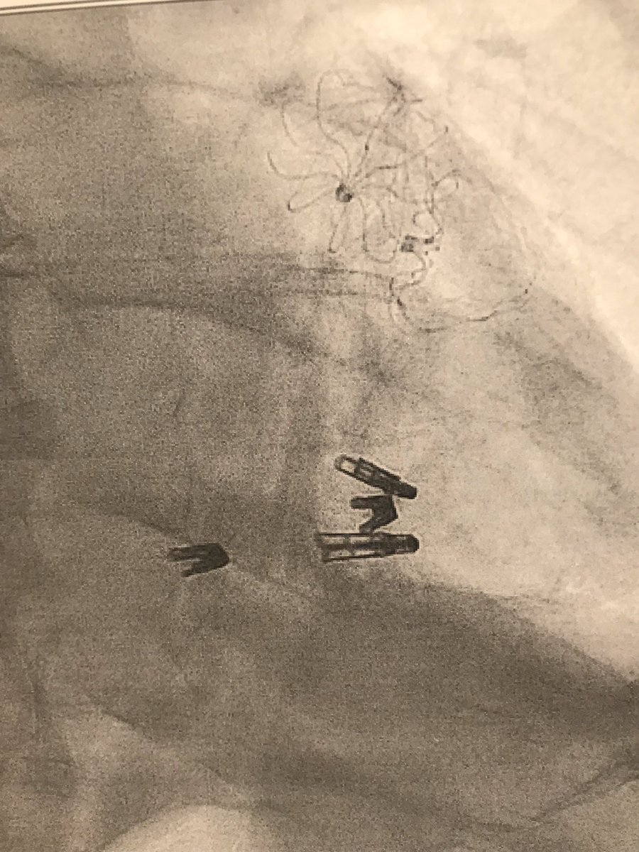 On its way to a bionic heart!!
2 years- 2 stents; 2 watchman; 3 mitraclips; 1 tricuspid clip