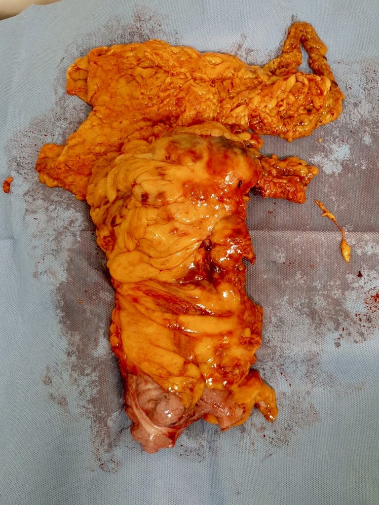 Cáncer del ángulo derecho del colon, con masa ganglionar en el origen de la arteria cólica superior derecha. Hemicolectomia derecha extendida y vaciamiento ganglionar D3