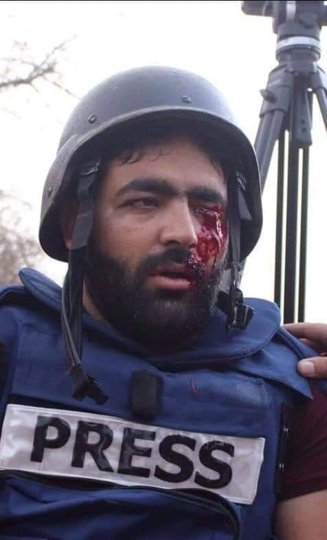 AlanqarManal's tweet photo. #Palestinian Journalist shot in his eye in the West Bank. 
Reuters/Mussa Qawasma https://t.co/8KSl2aWzMD