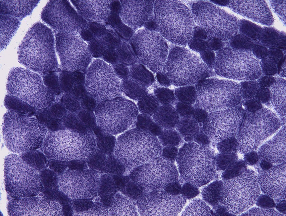 This is a quadriceps muscle biopsy of a 6-year-old boy with muscle weakness and failure to thrive since he was 6-months. H&amp;E, ATPase Ph 4.6, ATPase Ph 9.4 and NADH
