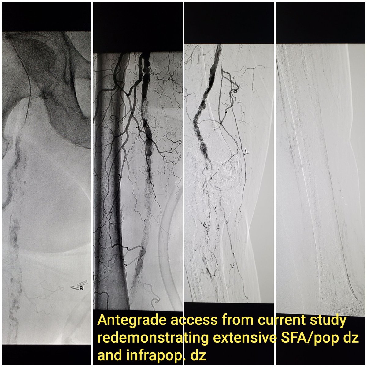 laronecampbell's tweet photo. 78m w DM, R foot necrotic wounds and calcaneus osteomyelitis. Antegrade access 2/2 tortuous iliacs. #atherectomy of prox #sfa. #stent placed across the knee #taboo . @SIR_ECS @SIRspecialists @CLIFightersBot #iRad #clifighters #InterventionalRadiology #LakelandVascular #savealeg https://t.co/6gBwv57PKg
